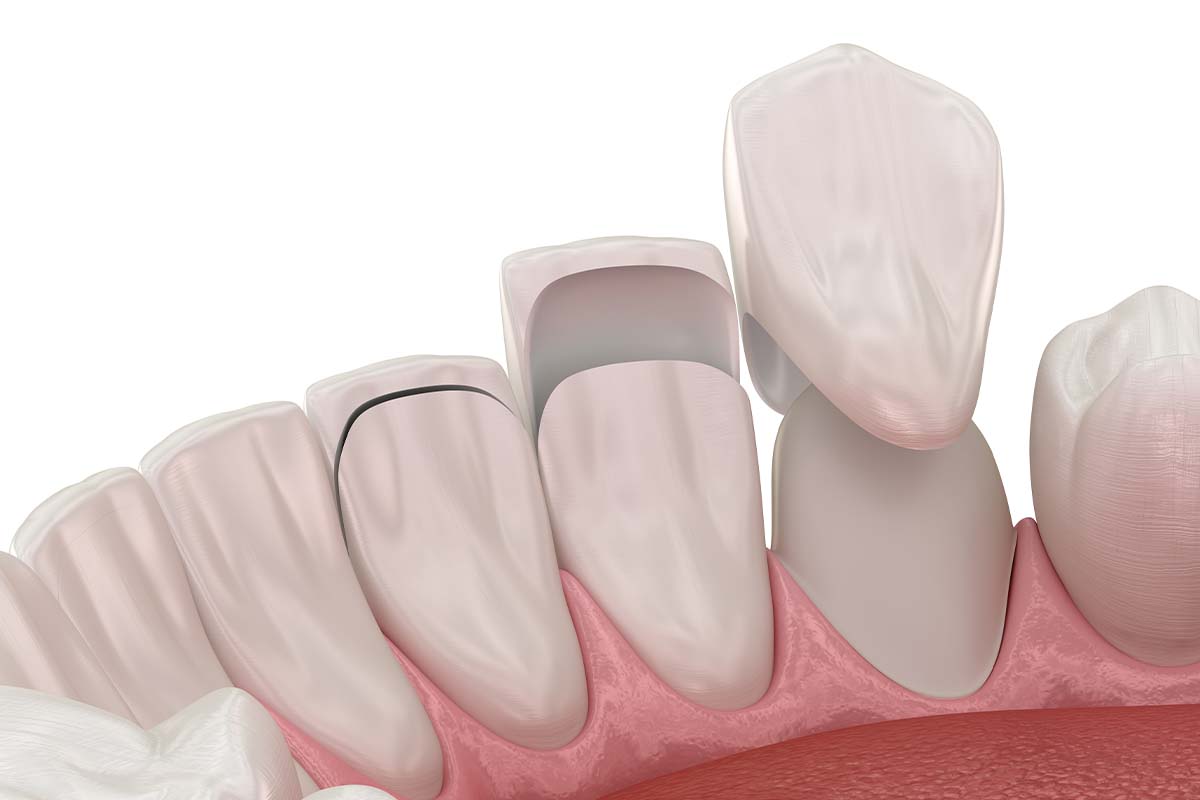 illustration of dental veneers